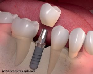 علل از دست دادن ایمپلنت کاشت دندان چیست؟