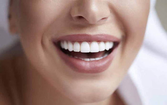 لمینت سرامیکی