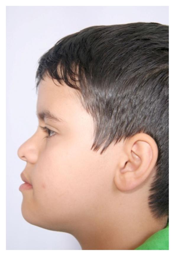 کوچکی فک بالا