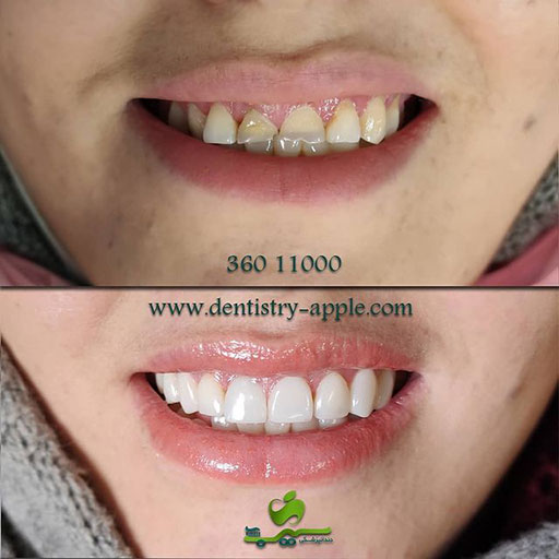 نمونه کار دندانپزشکی سیب پاکدشت