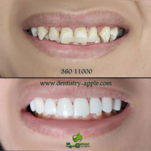 نمونه کار دندانپزشکی سیب پاکدشت