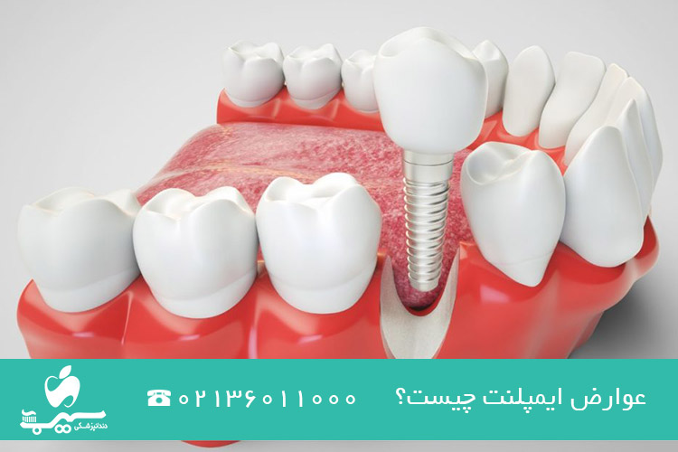عوارض ایمپلنت چیست؟