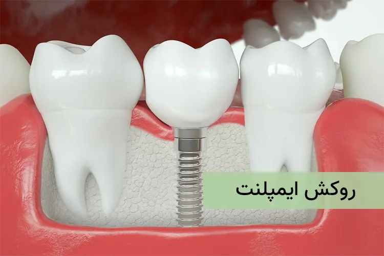 روکش ایمپلنت