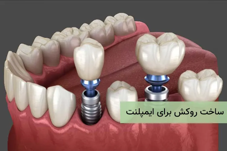 ساخت روکش برای ایمپلنت