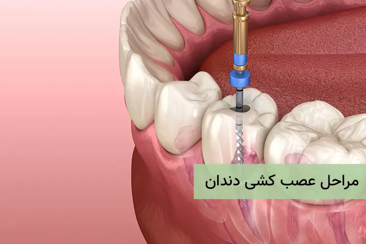 مراحل عصب کشی دندان