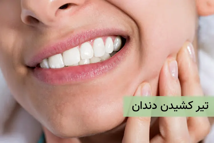 تیر کشیدن دندان