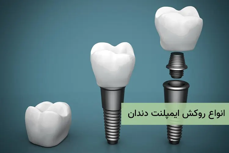 انواع روکش ایمپلنت دندان