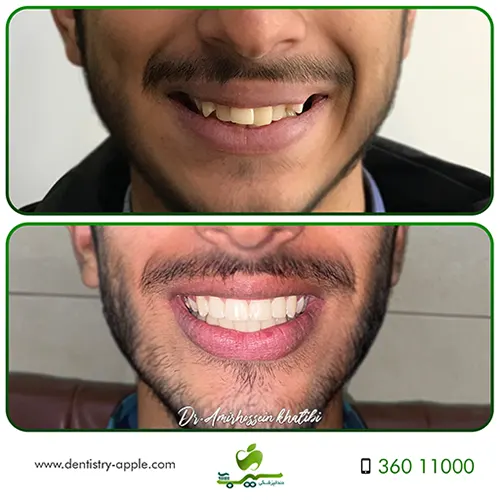 ارتودنسی برای اصلاح لبخند لثه ای