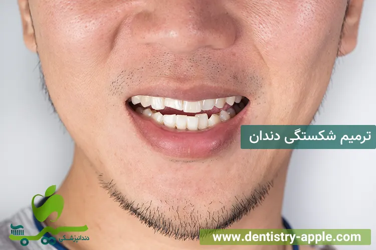 ترمیم شکستگی دندان
