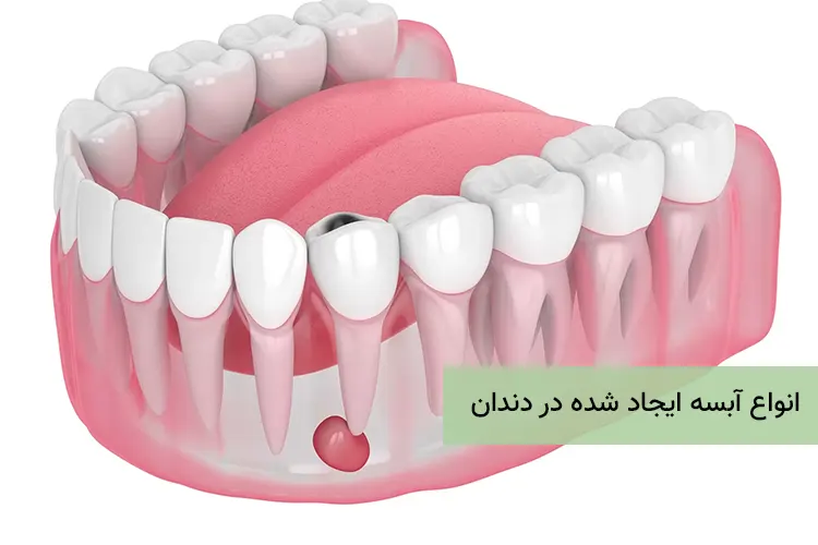 انواع آبسه ایجاد شده در دندان