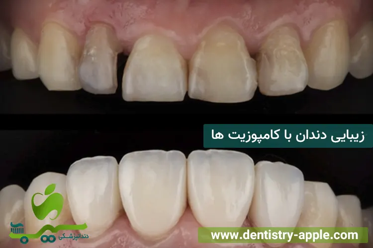 زیبایی دندان با کامپوزیت‌ ها