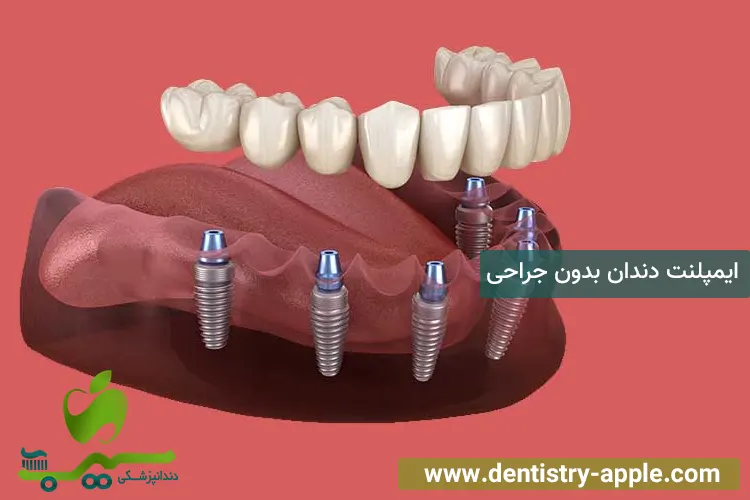 ایمپلنت دندان بدون جراحی
