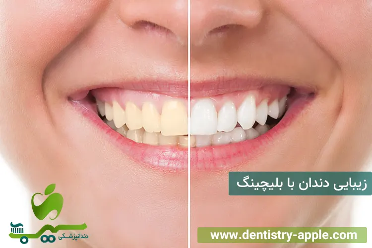 زیبایی دندان با بلیچینگ