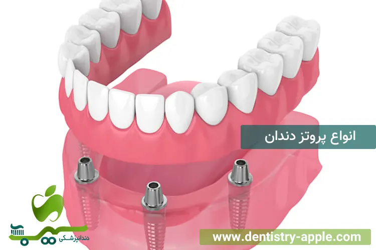 انواع پروتز دندان