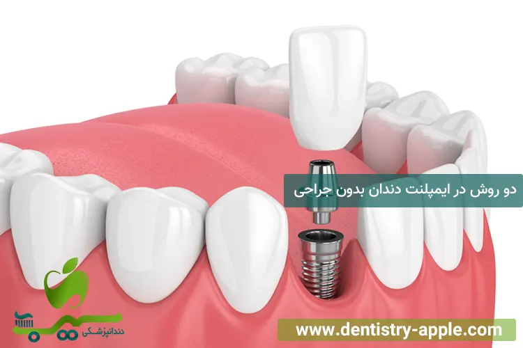 دو روش در ایمپلنت دندان بدون جراحی