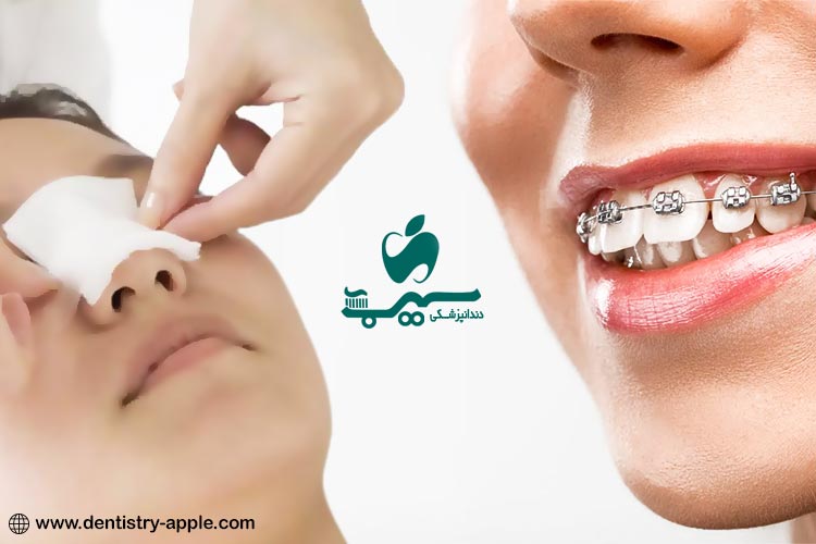 چه مدت بعد از ارتودنسی میتوان عمل بینی انجام داد؟