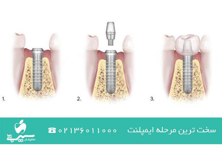 سخت ترین مرحله ایمپلنت 
