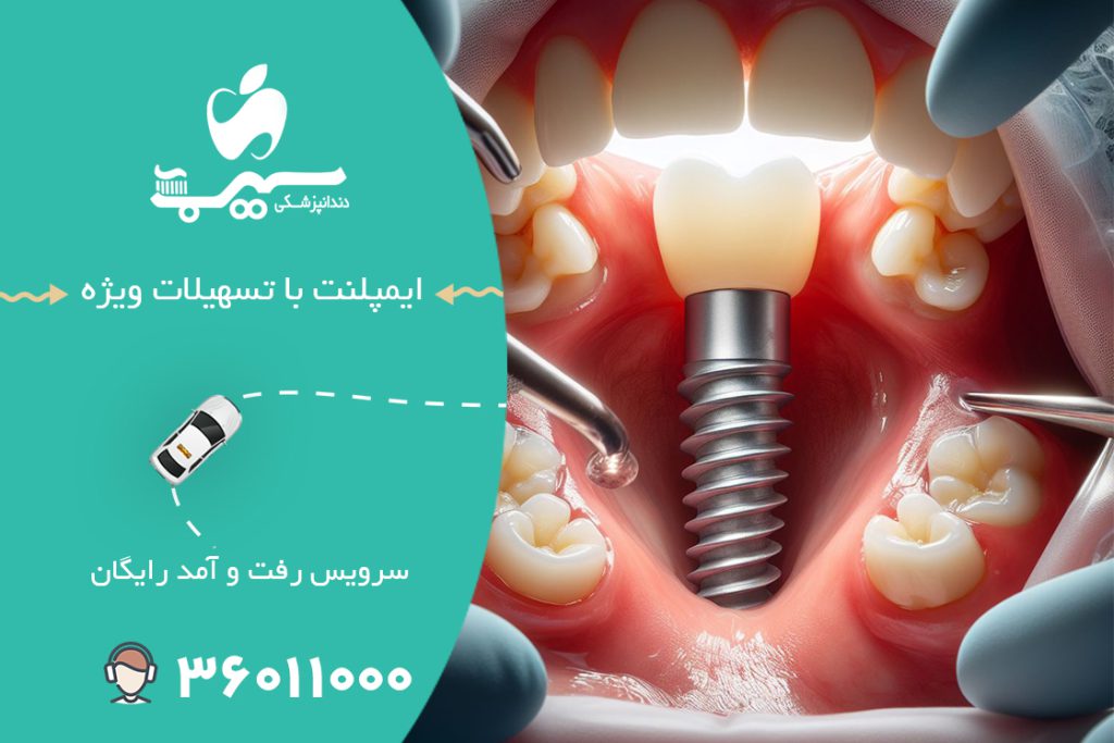 ایمپلنت با تسهیلات ویژه