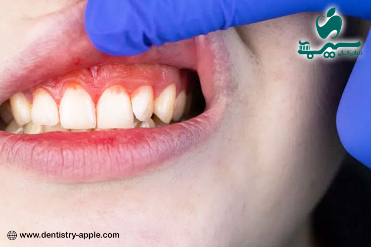 چه چیزی باعث خونریزی لثه می شود؟