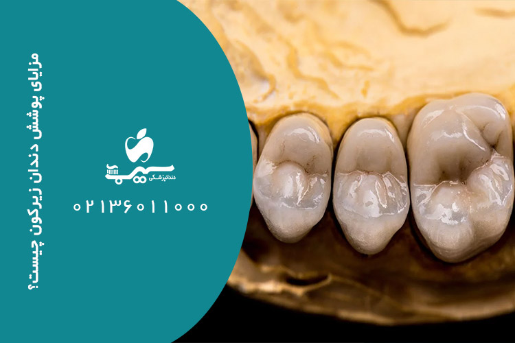 مزایای پوشش دندان زیرکون چیست؟