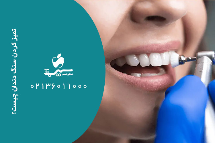 تمیز کردن سنگ دندان چیست؟ چگونه؟
