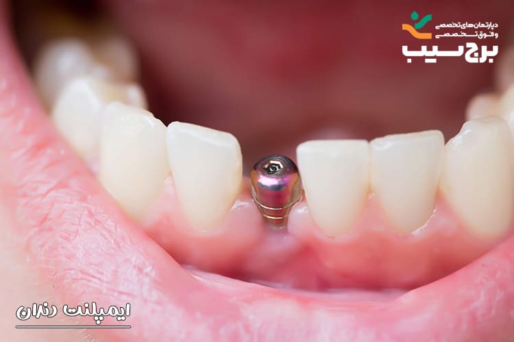 ایمپلنت دندان ساب پریوستئال