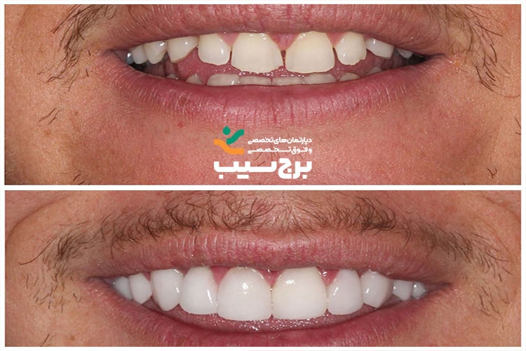 قبل و بعد دندان لبخند