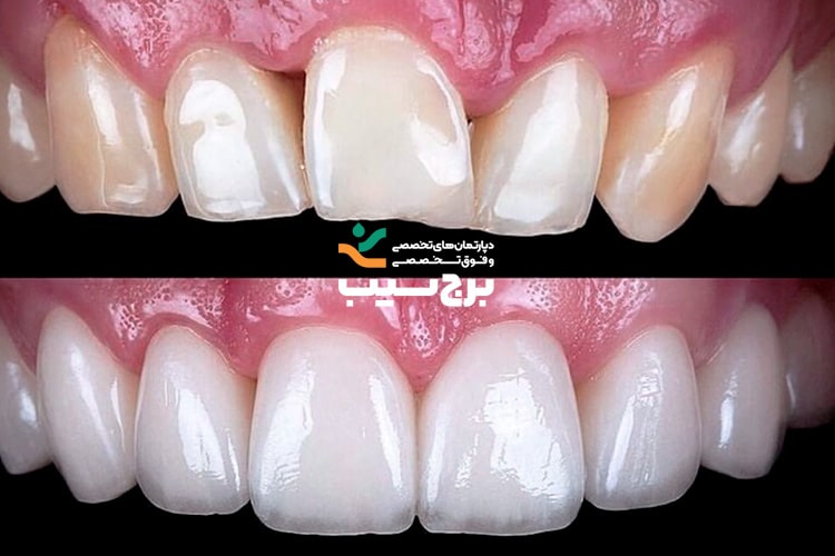 کاربرد لمینت